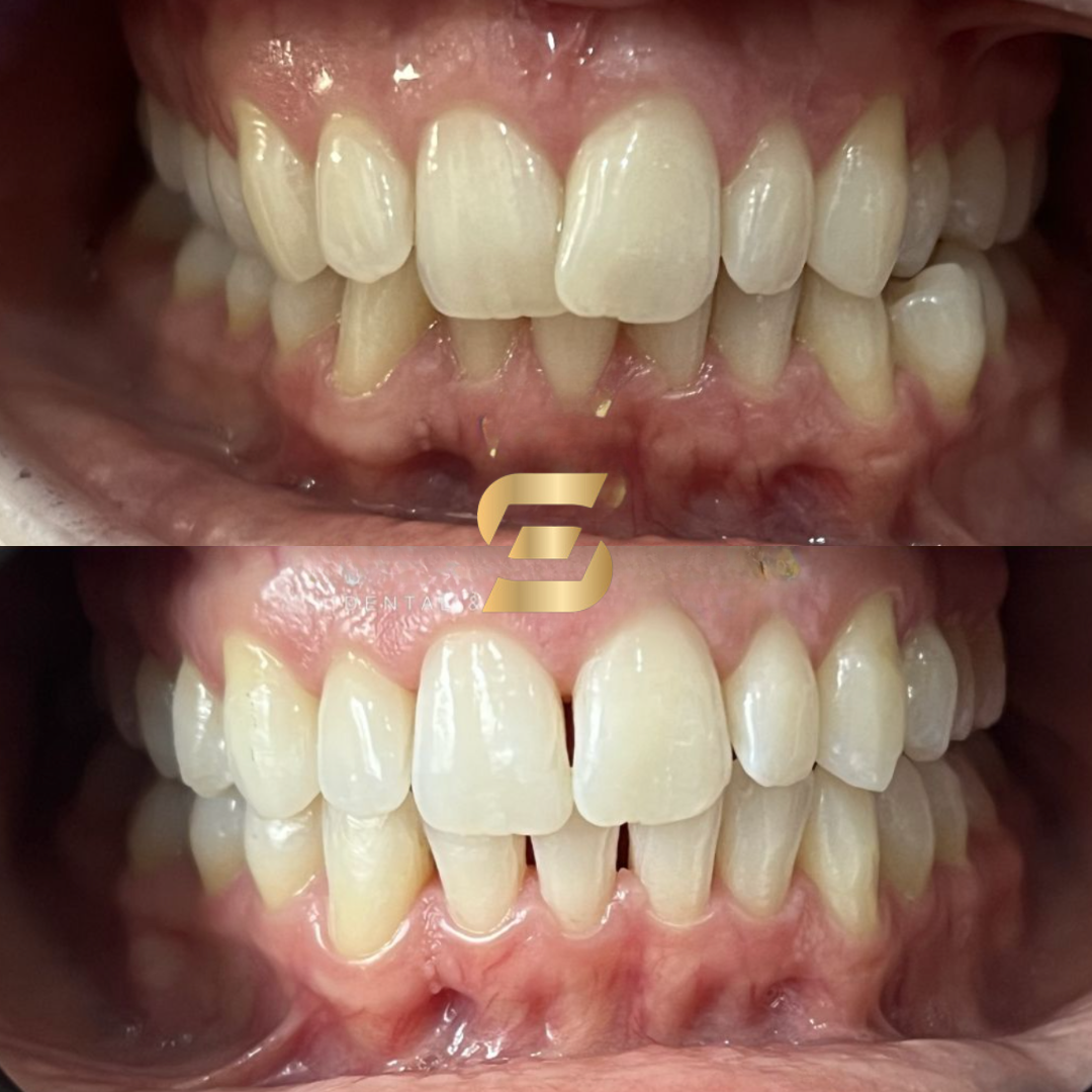 Before and after Invisalign treatment showing crowded front teeth brought into an even arch, Smile Perfections Oadby